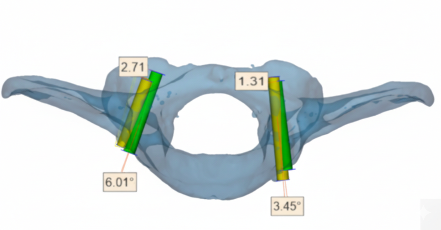 3D printed drill guides in canine spinal surgery